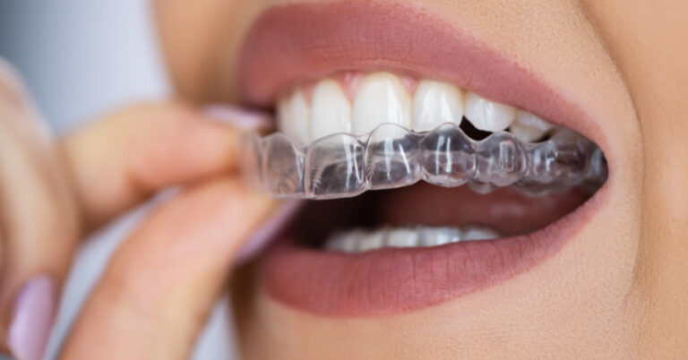 capa invisalign em fortaleza