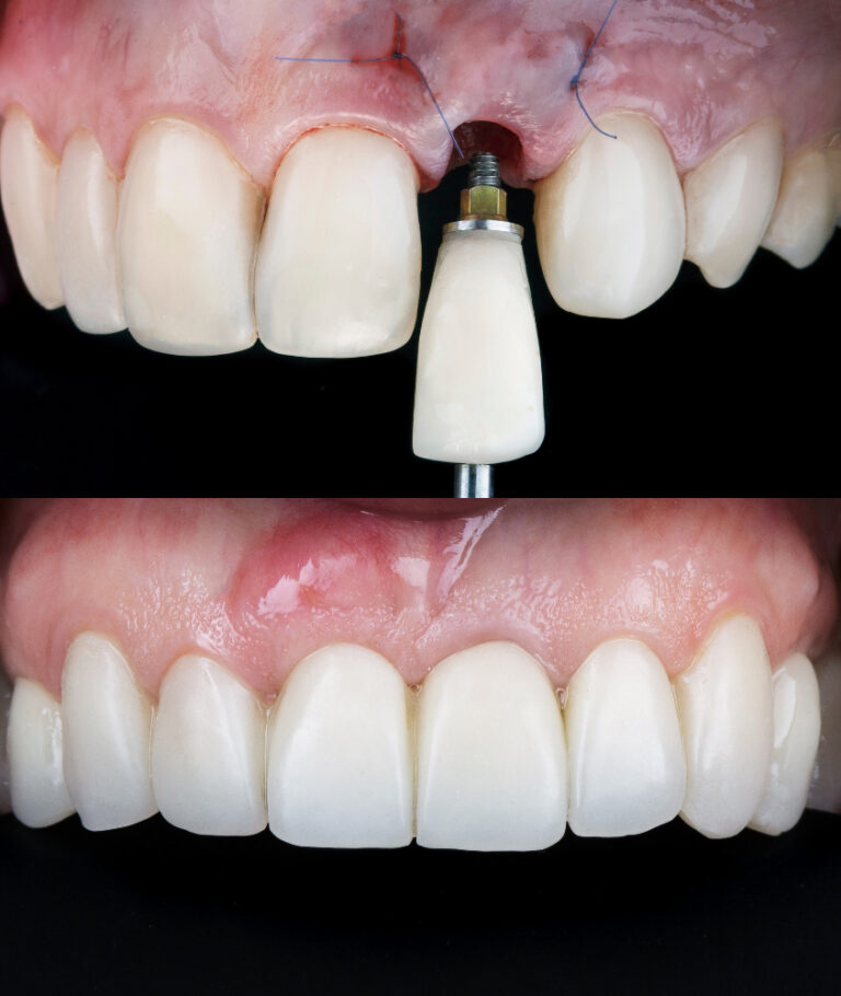 Implante Dentário em Fortaleza implante dentario antes e depois