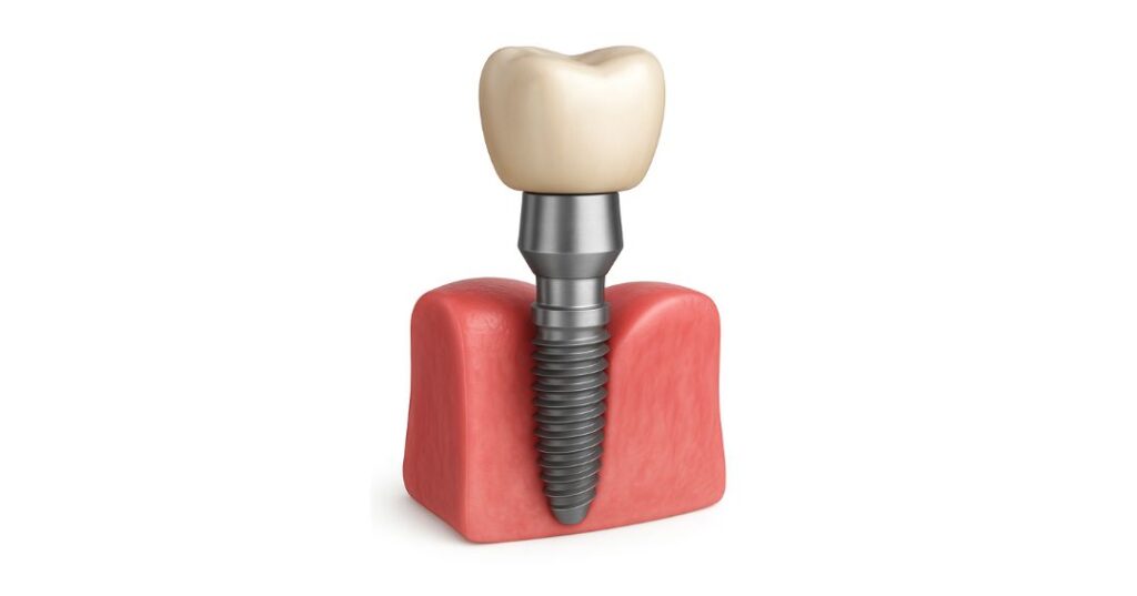Implante Dental