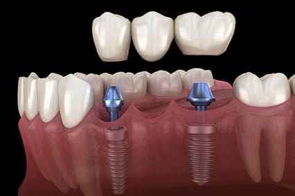 antes e depois implante dentario