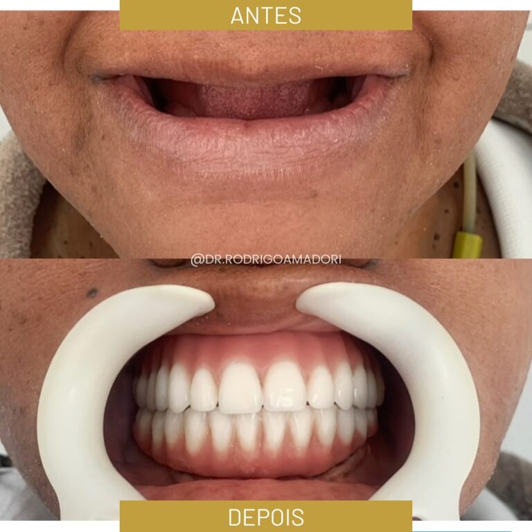 servico realizado implante dentario 2
