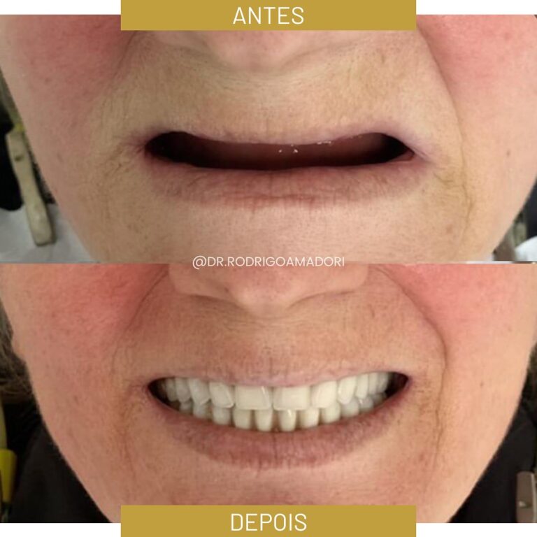 servico realizado implante dentario 3