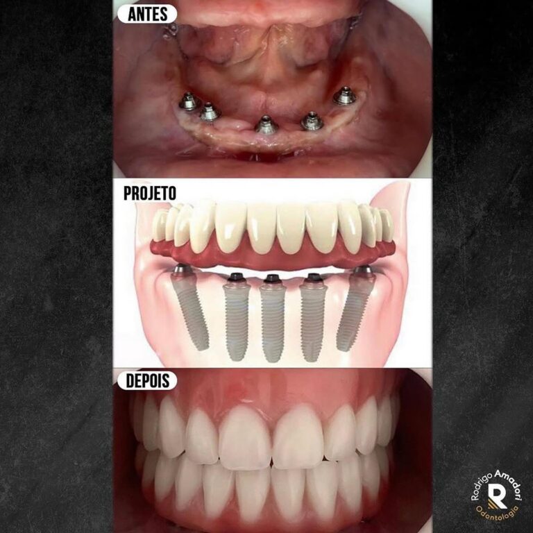 servico realizado implante dentario